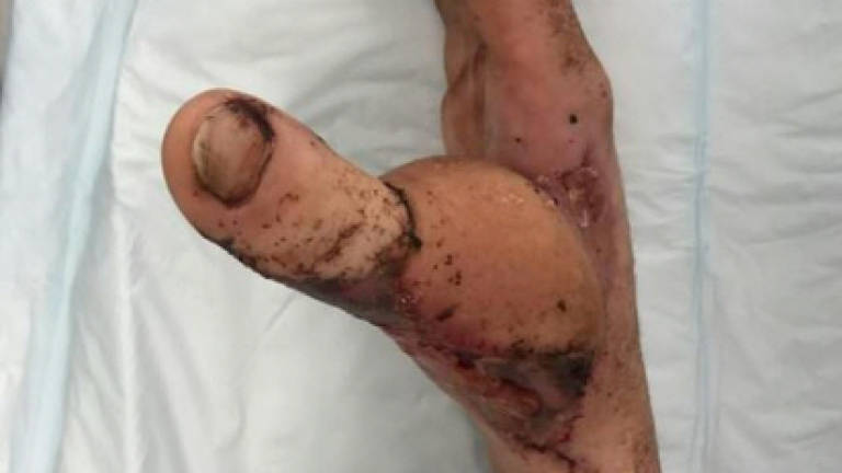 Australian has thumb surgically replaced with toe