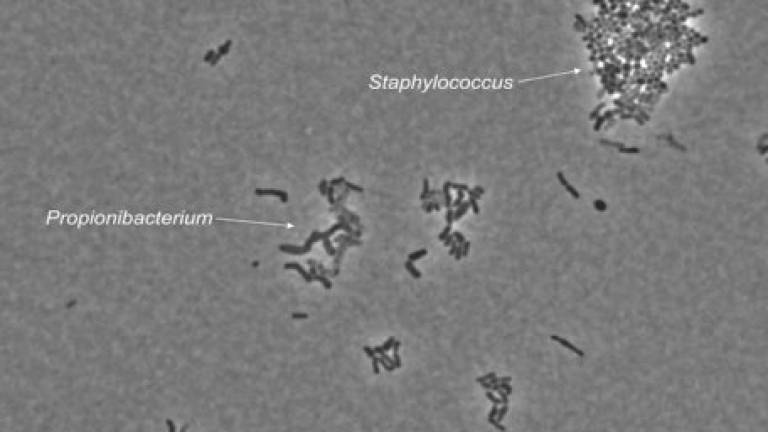Bacteria the yin and yang of dandruff, says study