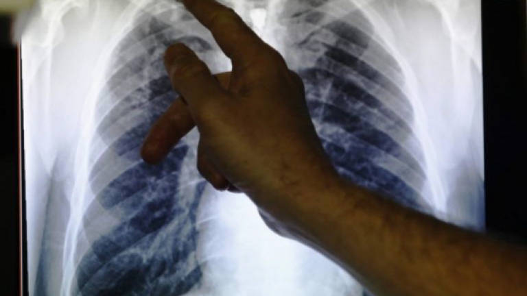 New lung transplant technique could save lives: Study