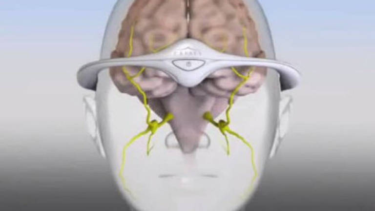 FDA approves device for preventing migraines