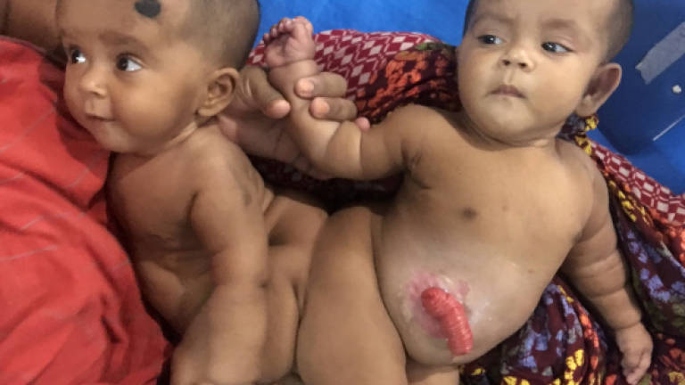 Bangladesh separates conjoined twins in rare surgery