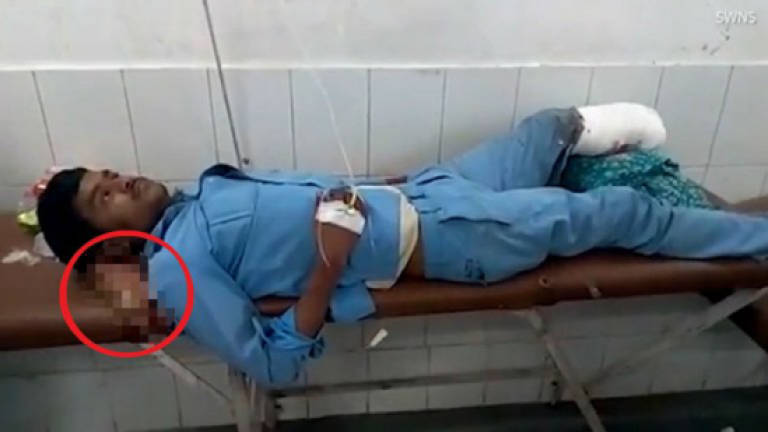 Accident victim made to lie with severed leg as a pillow (Video)
