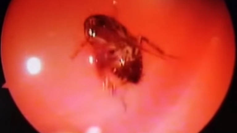 (Video) Doctor pulls live cockroach from woman's skull