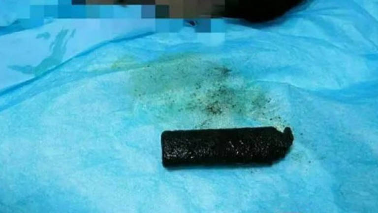 Lighter removed from stomach of man who swallowed it 20 years ago