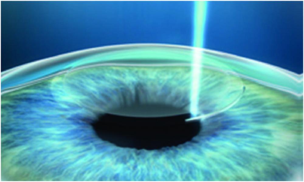 Keep in mind that laser vision correction is still a surgical procedure that carries surgical risk.