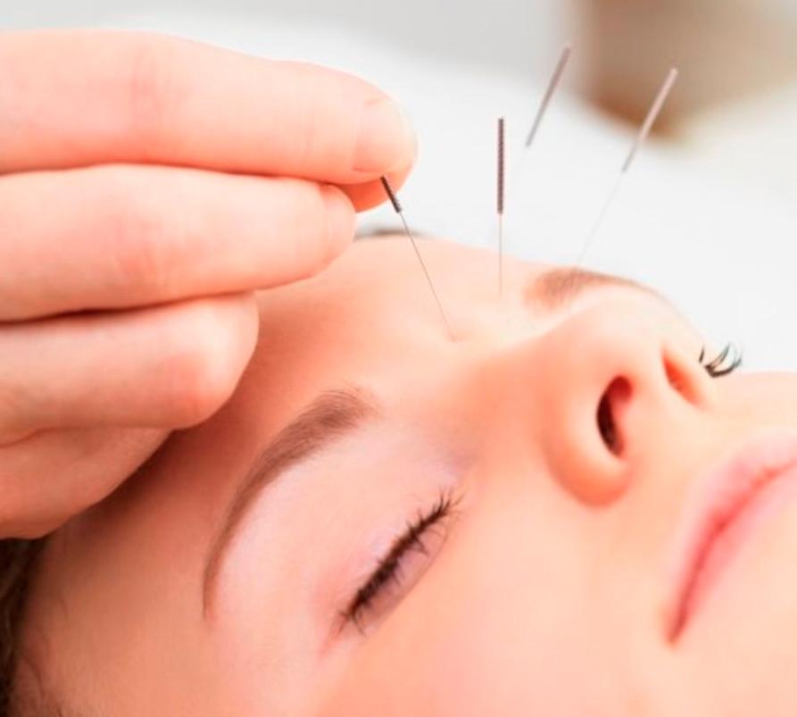 Facial acupuncture improves blood and lymph circulation, as it also increases collagen production.
