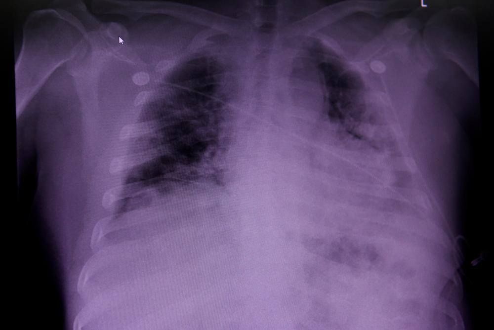 FILE PHOTO: An X-ray of a COVID-19 patient’s lungs at United Memorial Medical Center in Houston, Texas, U.S., July 10, 2020. REUTERS/Callaghan O’Hare/File Photo