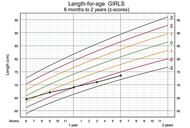 $!(above) This example illustrates a girl whose height at 6 months old was at 0 to -1 on the scale, who has steadily dropped into -2 to -3 by age 18 months old. It is clear that her parameter “crosses the lines” progressively with each visit. This girl has faltering growth and requires immediate intervention.