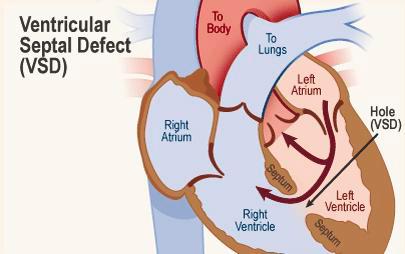 $!VSD is an opening or hole (defect) in the wall (septum) separating the two lower chambers of the heart (ventricles).
