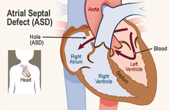 $!An atrial septal defect is a birth defect of the heart in which there is a hole in the wall (septum) that divides the upper chambers (atria) of the heart.