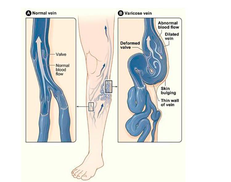 When the unidirectional flow of blood fails, it will lead to the development of varicose veins. $!When the unidirectional flow of blood fails, it will lead to the development of varicose veins.