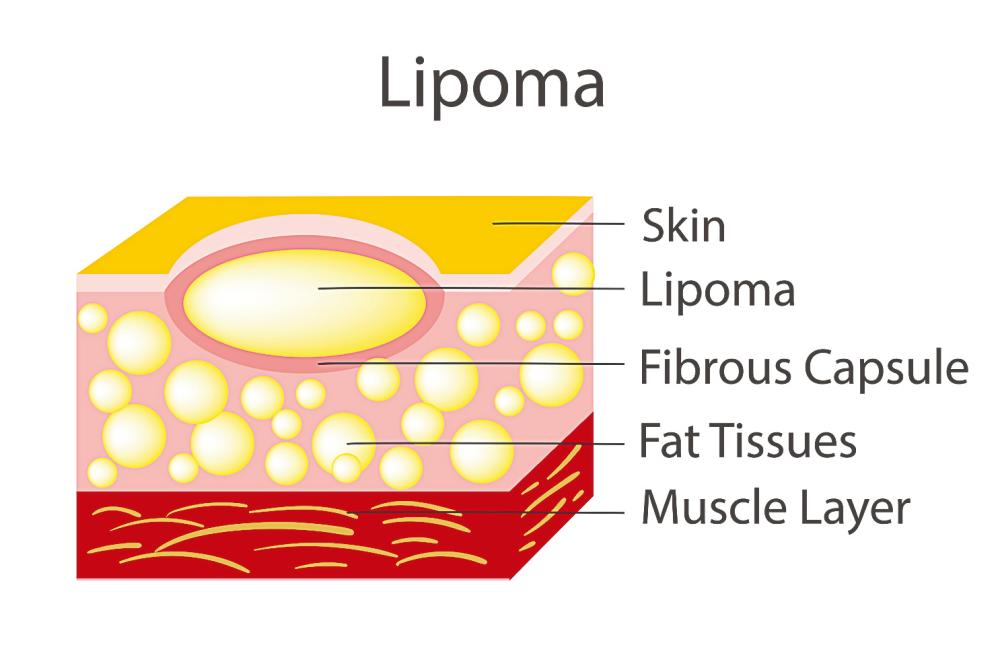 $!(below) Checking a lipoma at an early stage is always better.