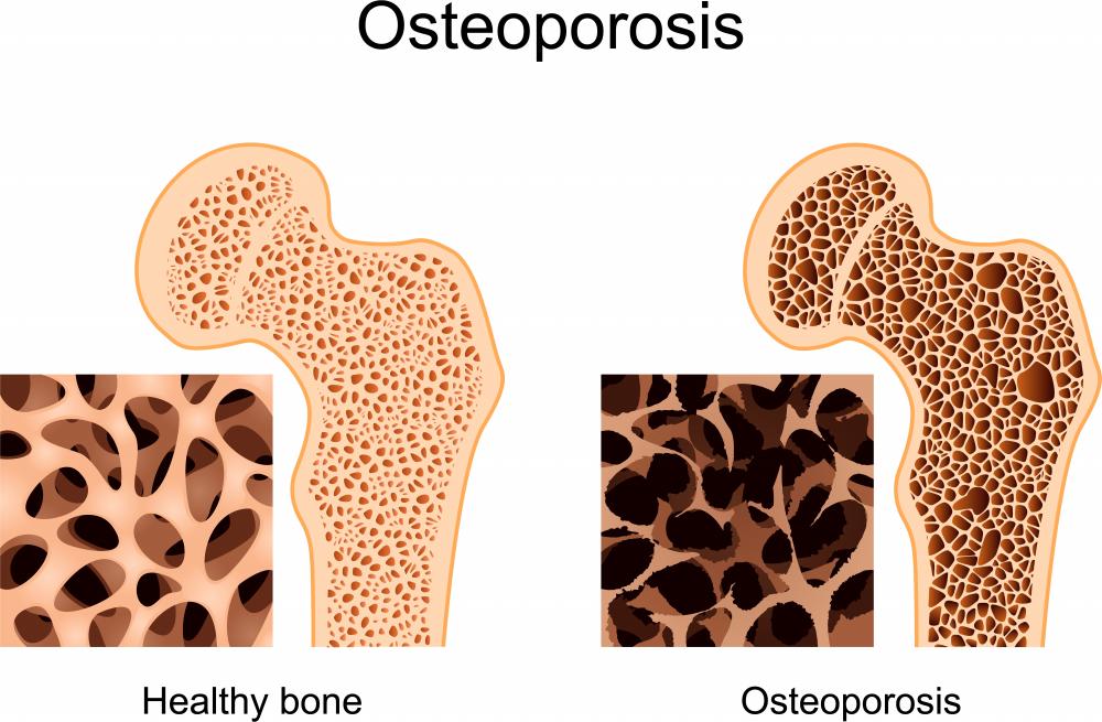 $!The differences between the bones of a healthy person, and a person with osteoporosis.