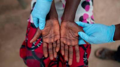 South Africa records third mpox death, cases on the rise in Africa
