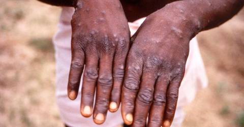 Fears new ‘most dangerous’ mpox strain could cross borders