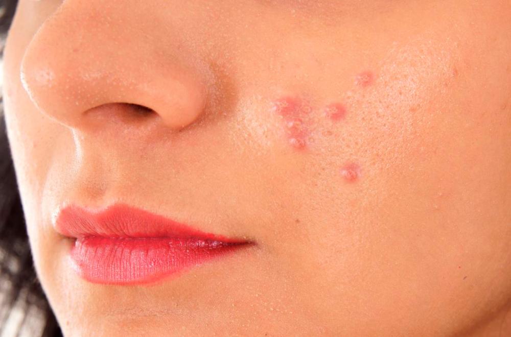 Acne is a common skin condition that occurs when the pores of your skin become blocked with oily substances and dead skin cells. – QUICKOBOOK