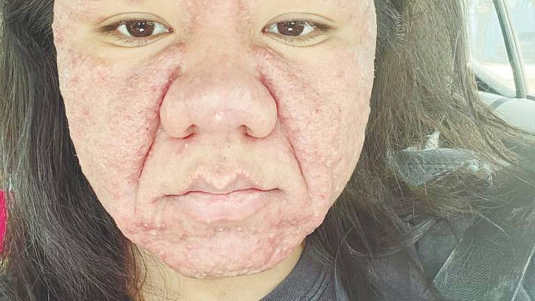 Farah, now eight months pregnant, is grappling with a rare skin disorder. – Courtesy pic
