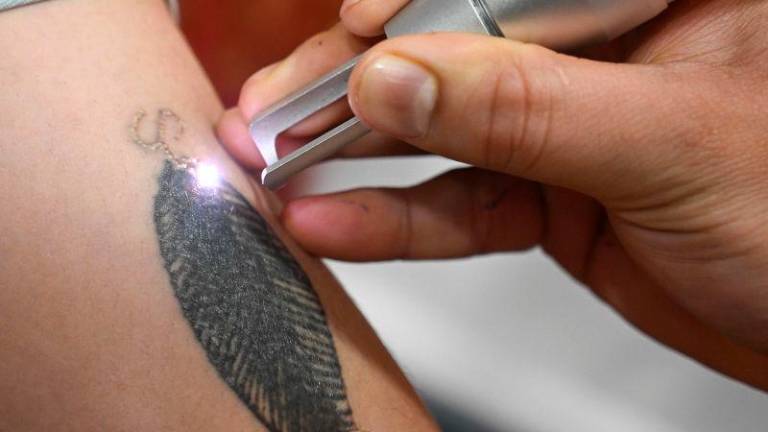In this picture taken on April 22, 2025, Basit Bashir, a tattoo removal artist, uses a laser machine to remove tattoos from the arm of a resident in his clinic in Srinagar.AFPpix
