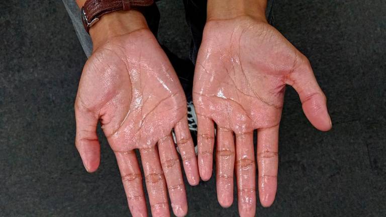 Hyperhidrosis, or excessive sweating, affects up to 3% of Malaysians but remains underdiagnosed and misunderstood, said Sultan Idris Shah Hospital internal medicine physician and dermatologist Dr Ishvant Kaur Sidhu. SYED AZAHAR SYED OSMAN THESUN