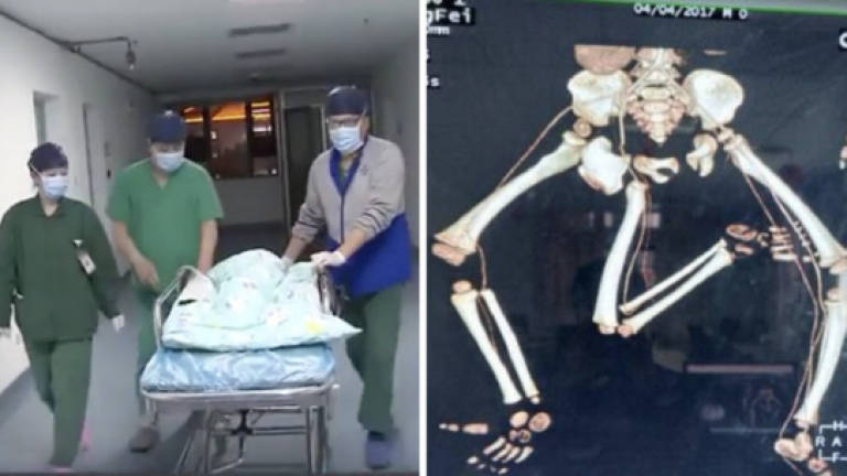 Baby born with three legs has extra limb removed (Video)