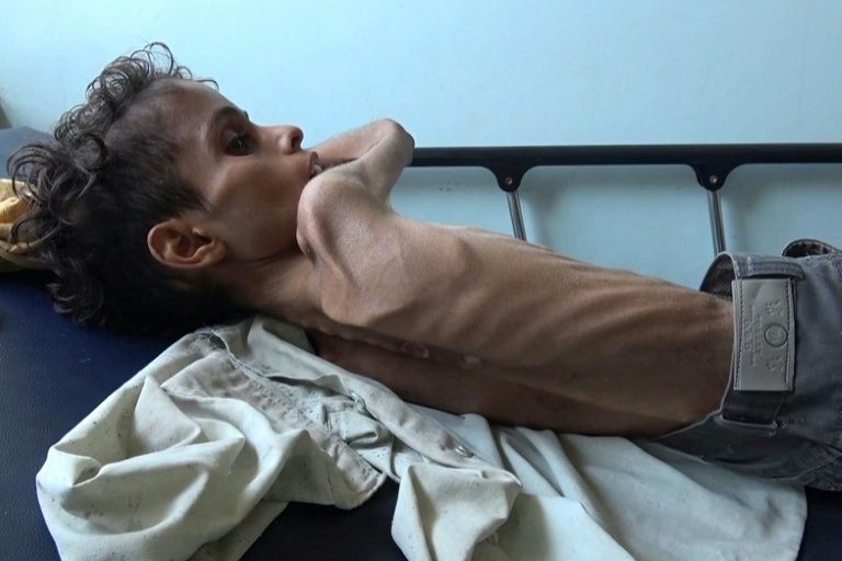 Ghazi Saleh, 10, lies on a bed at Al-Mudhafar hospital in Taez on November 19, 2018. — AFP