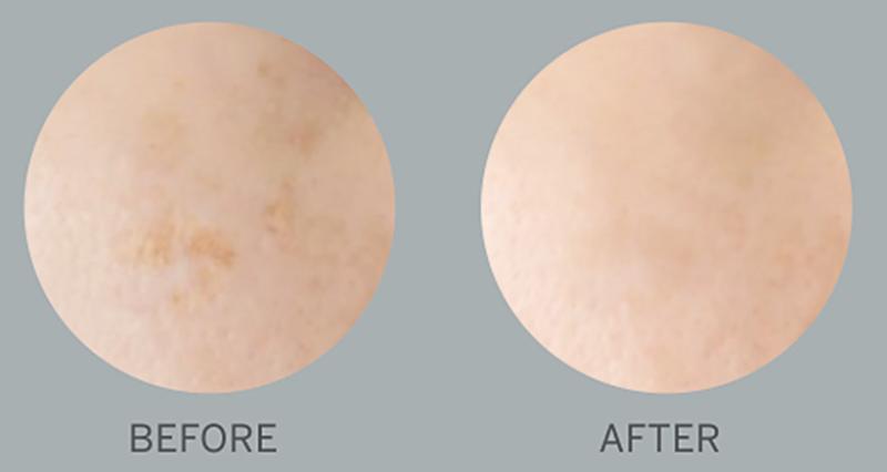 Photographs taken in daylight without makeup, using NIVEA LUMINOUS630 SPOTCLEAR Booster Serum. $!Photographs taken in daylight without makeup, using NIVEA LUMINOUS630 SPOTCLEAR Booster Serum.