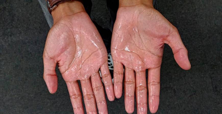 Hyperhidrosis, or excessive sweating, affects up to 3% of Malaysians but remains underdiagnosed and misunderstood, said Sultan Idris Shah Hospital internal medicine physician and dermatologist Dr Ishvant Kaur Sidhu. SYED AZAHAR SYED OSMAN THESUN