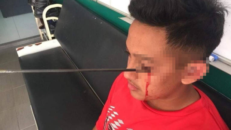 A Form Four boy in Gurun went through a horrific experience when an arrow pierced through the left side of his face in a freak incident Thursday evening. — Facebook pix courtesy of Kedah Kini