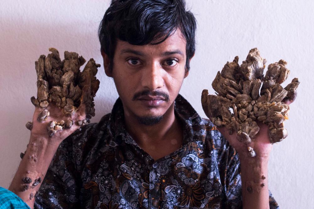 Abul Bajandar , 28, dubbed Tree Man for massive bark-like warts on his hands and feet, sits at Dhaka Medical College Hospital in Dhaka on June 24, 2019. — AFP