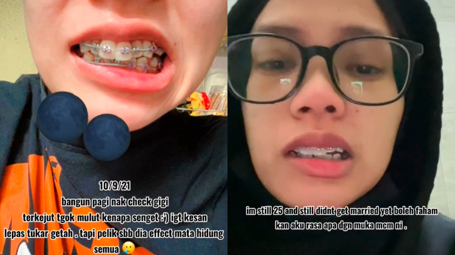 Malaysian woman recounts horror of waking up with a drooping mouth
