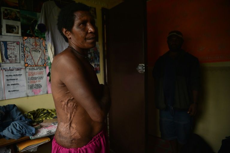 Mother-of-two Rachel shows the scars from wounds inflicted on her in April 2017 when she was accused of sorcery and tortured with hot machetes, spades and rods for a full day by people she knew in the Tsak Valley in the Highlands of Papua New Guinea. — AFP