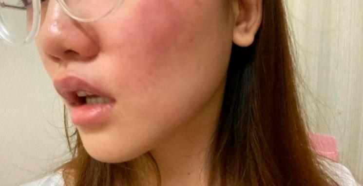 $!An image shared by Vestene showing the bruise on her face. – Facebook/@Vestene Wong