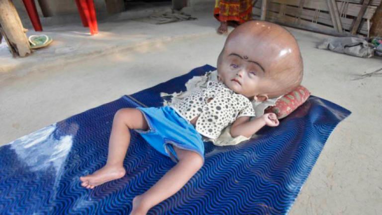 A picture of an infant with Hydroceplus/REUTERSPix