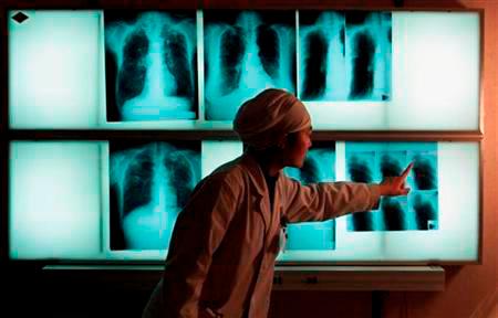 File photo shows a doctor examining an x-ray of a tuberculosis patient at the Beijing Tuberculosis Hospital/REUTERSPIX