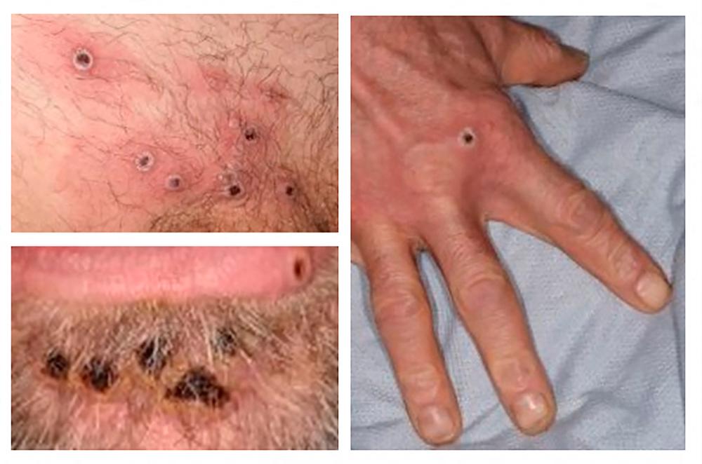 Photo taken on June 22, 2022 made available by the UK Health Security Agency (UKHSA) shows a collage of monkeypox rash lesions at an undisclosed date and location. AFPPIX
