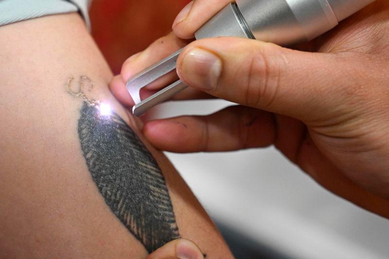 In this picture taken on April 22, 2025, Basit Bashir, a tattoo removal artist, uses a laser machine to remove tattoos from the arm of a resident in his clinic in Srinagar.AFPpix