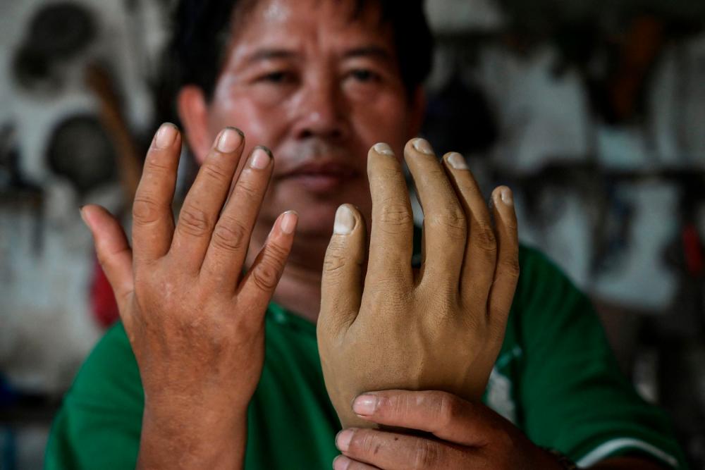 This photo taken on January 18, 2023 shows former leprosy patient Ali Saga displaying a prosthetic hand (R) as he compares it to his own hand inside his workshop in Tangerang, where he makes artificial limbs at affordable prices for people with disabilities. AFPPIX