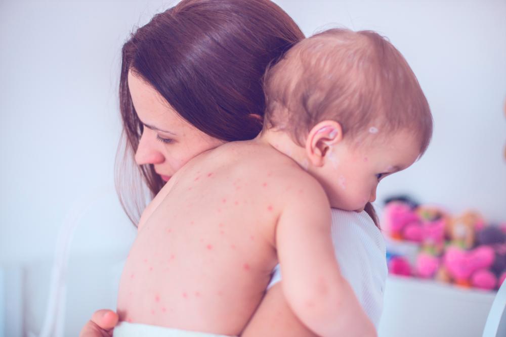 About 142,300 people lost their lives to measles in 2018 – a quarter of the number of deaths in 2000, but up 15 percent compared to 2017. © South_agency/IStock.com