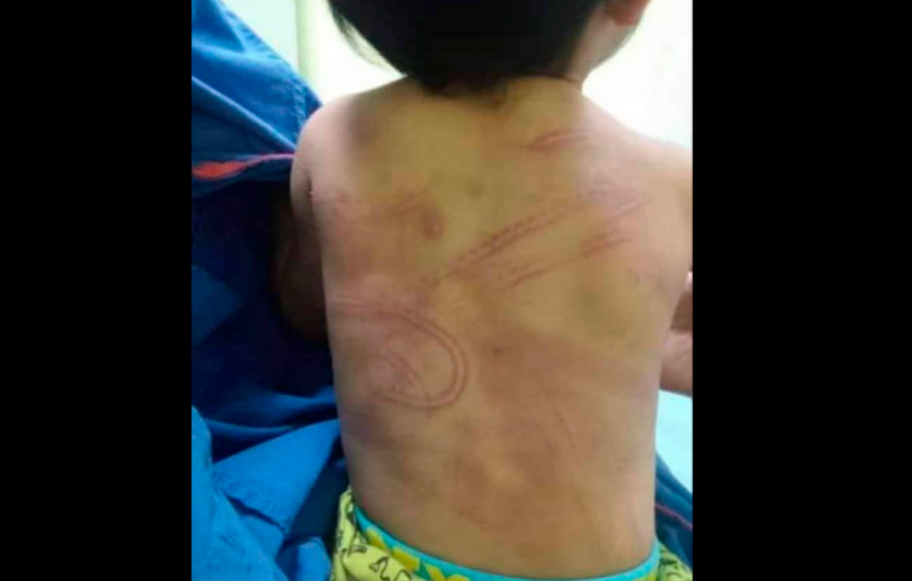 Seorang bayi perempuan berusia setahun 11 bulan cedera dipercayai didera teman lelaki ibunya. Kredit foto: Media sosial.
