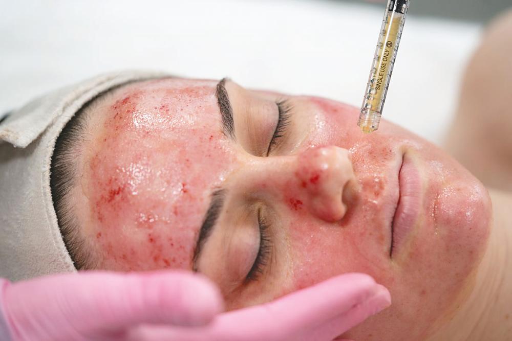 Drops of PRP will be applied on the face during the microneedling process, stimulating the body’s natural healing properties. – RN Aesthetics
