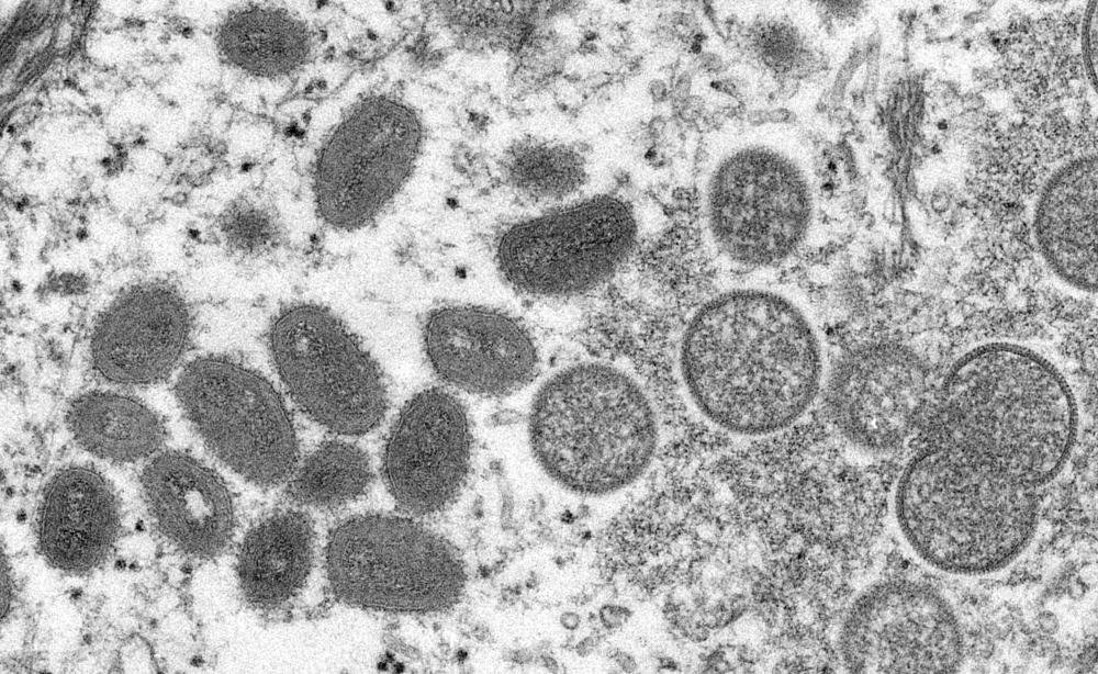 An electron microscopic (EM) image shows mature, oval-shaped monkeypox virus particles as well as crescents and spherical particles of immature virions, obtained from a clinical human skin sample associated with the 2003 prairie dog outbreak in this undated image obtained by Reuters on May 18, 2022. Cynthia S. Goldsmith, Russell Regnery/CDC/Handout via REUTERSpix
