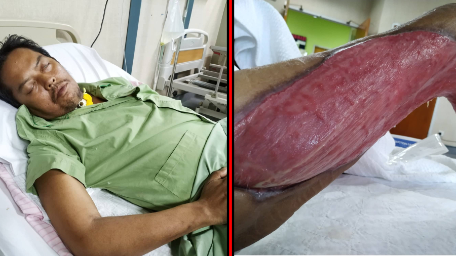 This man spends RM3k a month because he suffers from a flesh-eating disease