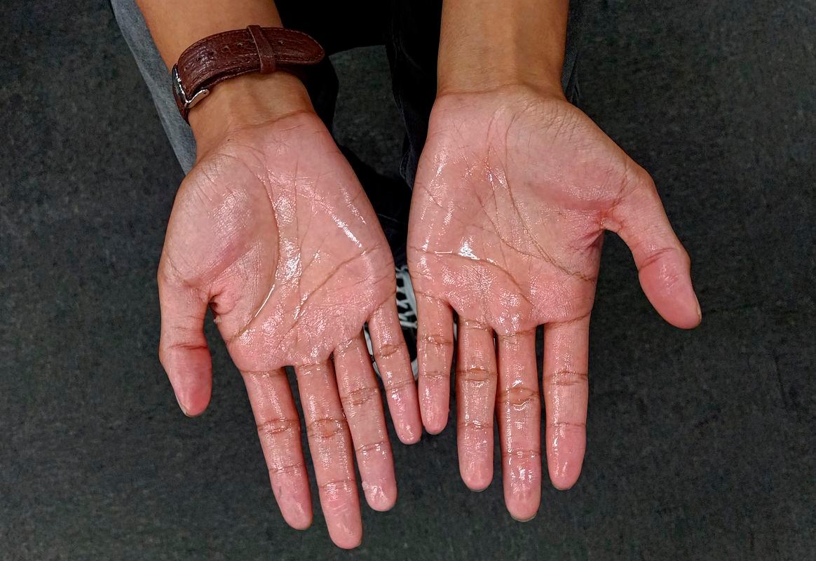 Hyperhidrosis, or excessive sweating, affects up to 3% of Malaysians but remains underdiagnosed and misunderstood, said Sultan Idris Shah Hospital internal medicine physician and dermatologist Dr Ishvant Kaur Sidhu. SYED AZAHAR SYED OSMAN THESUN