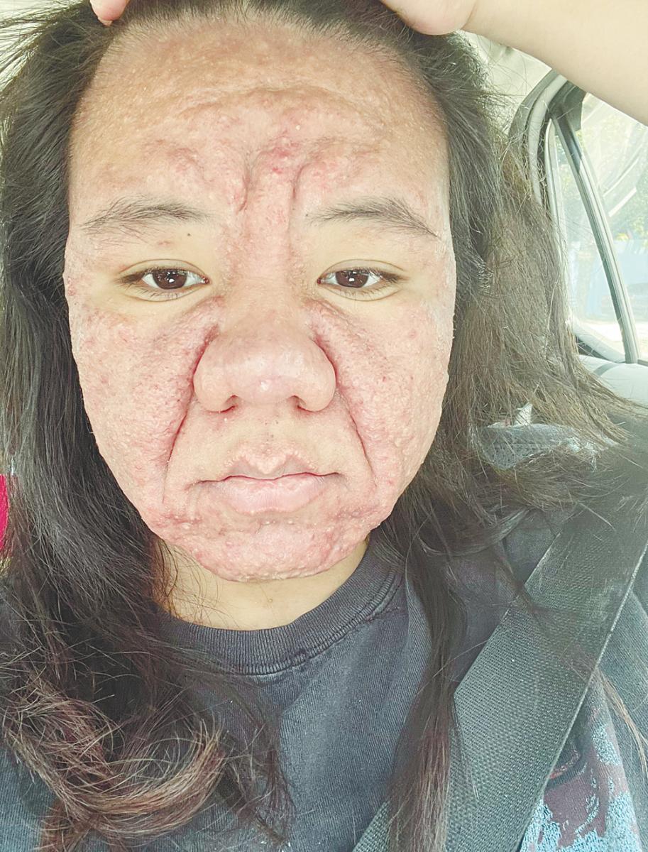 Farah, now eight months pregnant, is grappling with a rare skin disorder. – Courtesy pic