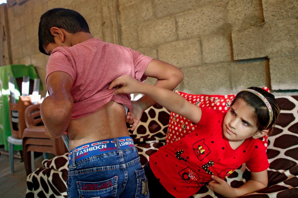 Yamin, an eight-year-old Palestinian shows his back during the war in 2014, as his siter Geina lifts his shirt at the home of their adoptive parents in central Gaza on Aug 21, 2019. — AFP