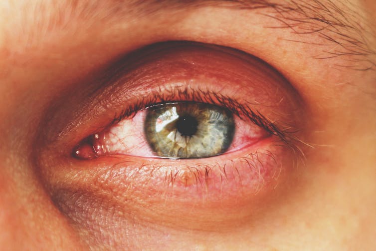 Pink eye is just one of the risks of using contaminated eye makeup. Sergey Granev/Shutterstock