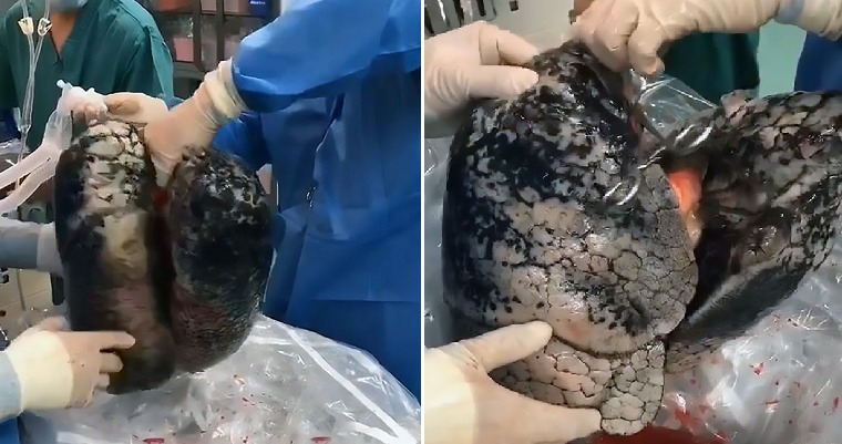 The image of a dead smoker’s lungs which has gone viral.