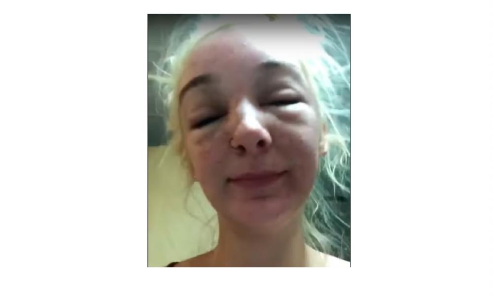 Screenshot of the woman’s face after the apparent sun poisoning.