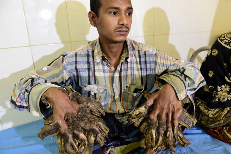 Abul Bajandar of Bangladesh, dubbed Tree Man for the massive bark-like warts on his hands and feet, sits at the Dhaka Medical College Hospital in January 2016. — AFP