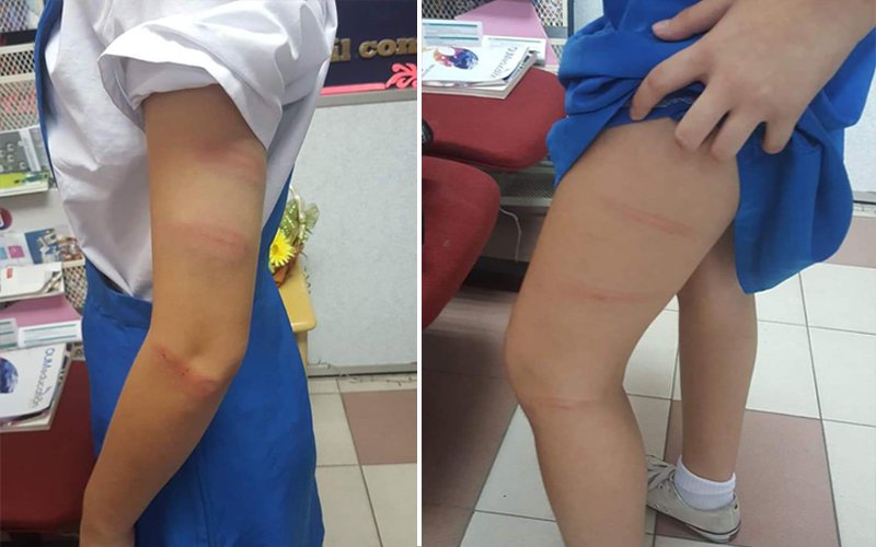 Student left with red marks after being caned by teacher